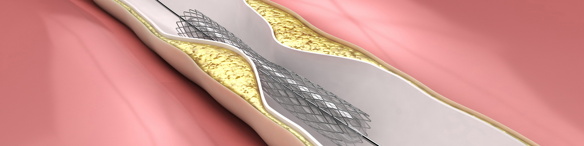 Stenosis & Strictures